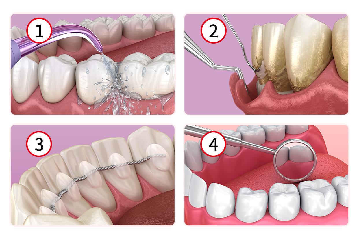 牙周治疗四个步骤图解