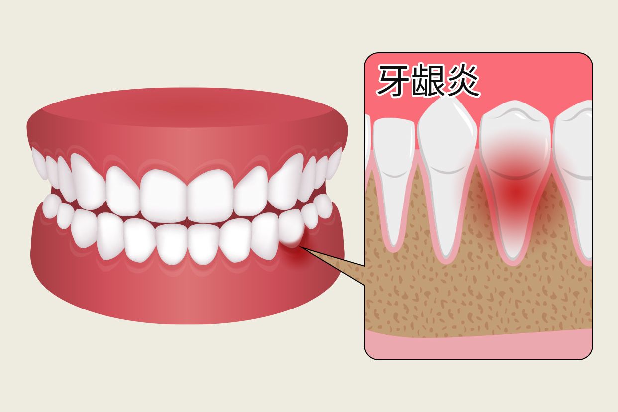 牙龈炎早期症状图片