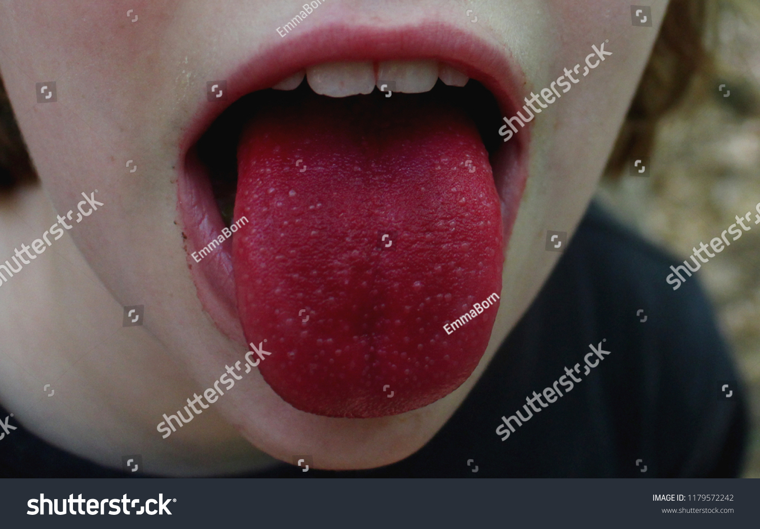 舌红是什么症状图片