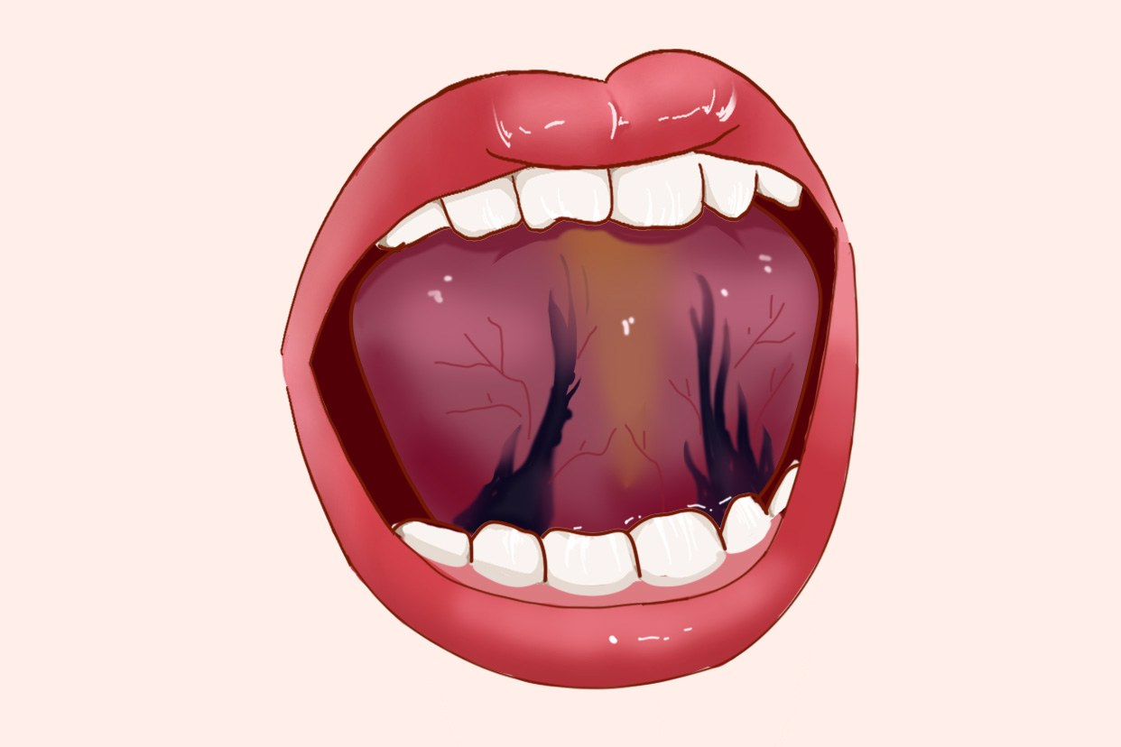 舌根淤堵图片