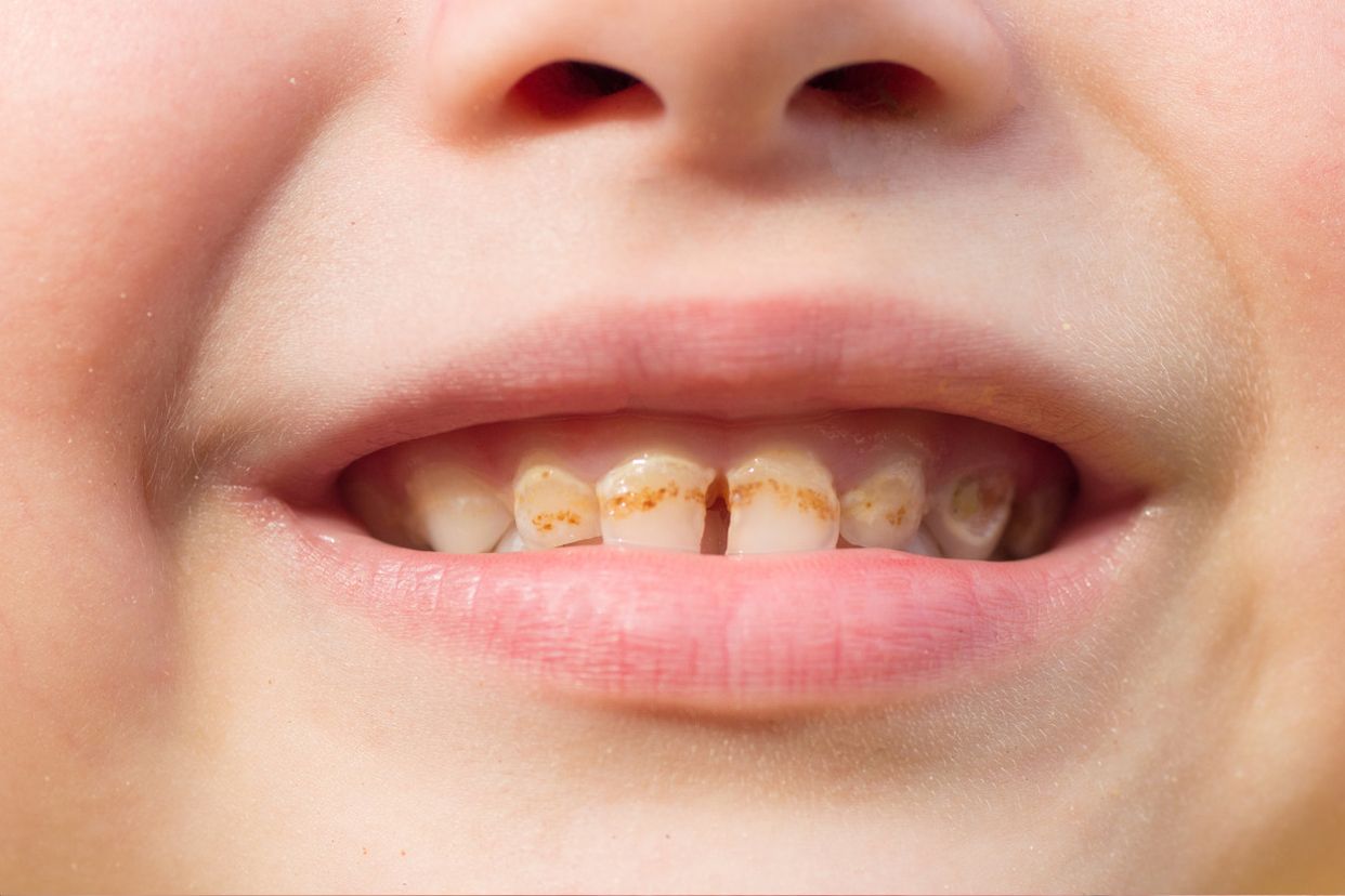 门牙龋齿严重程度分型图片