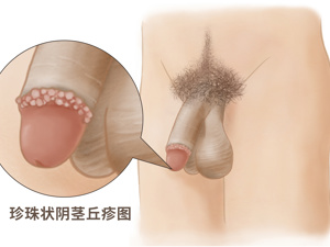 冠状沟皮脂腺异位图片