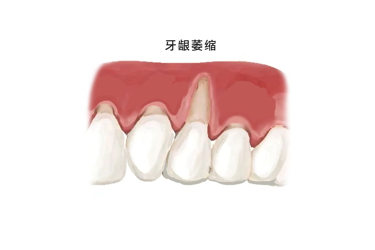 戴牙套牙龈萎缩图片