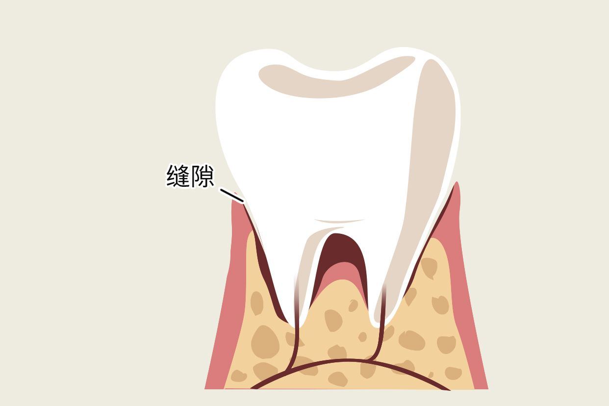 牙冠和牙龈有缝隙图