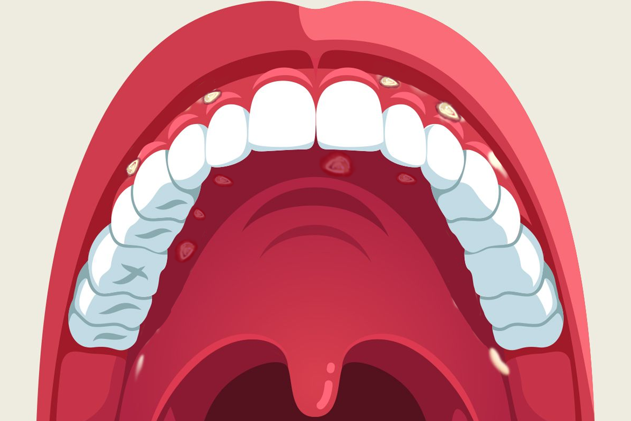 牙龈两侧溃疡图片