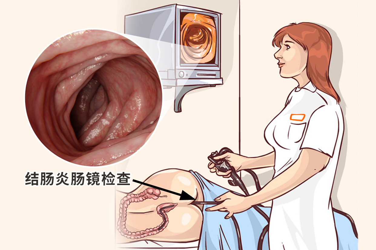 结肠炎肠镜检查图片
