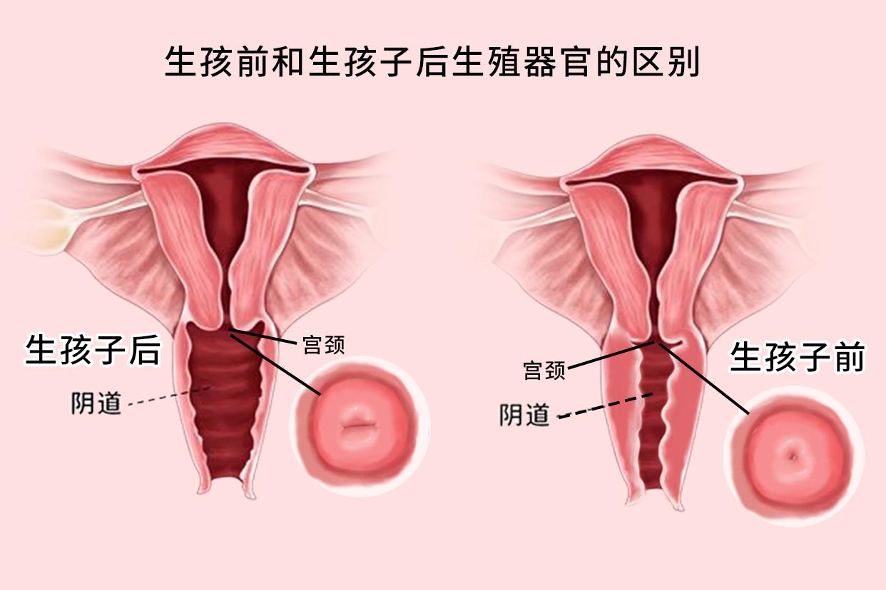 生孩前和生孩子后生殖器官的区别图片