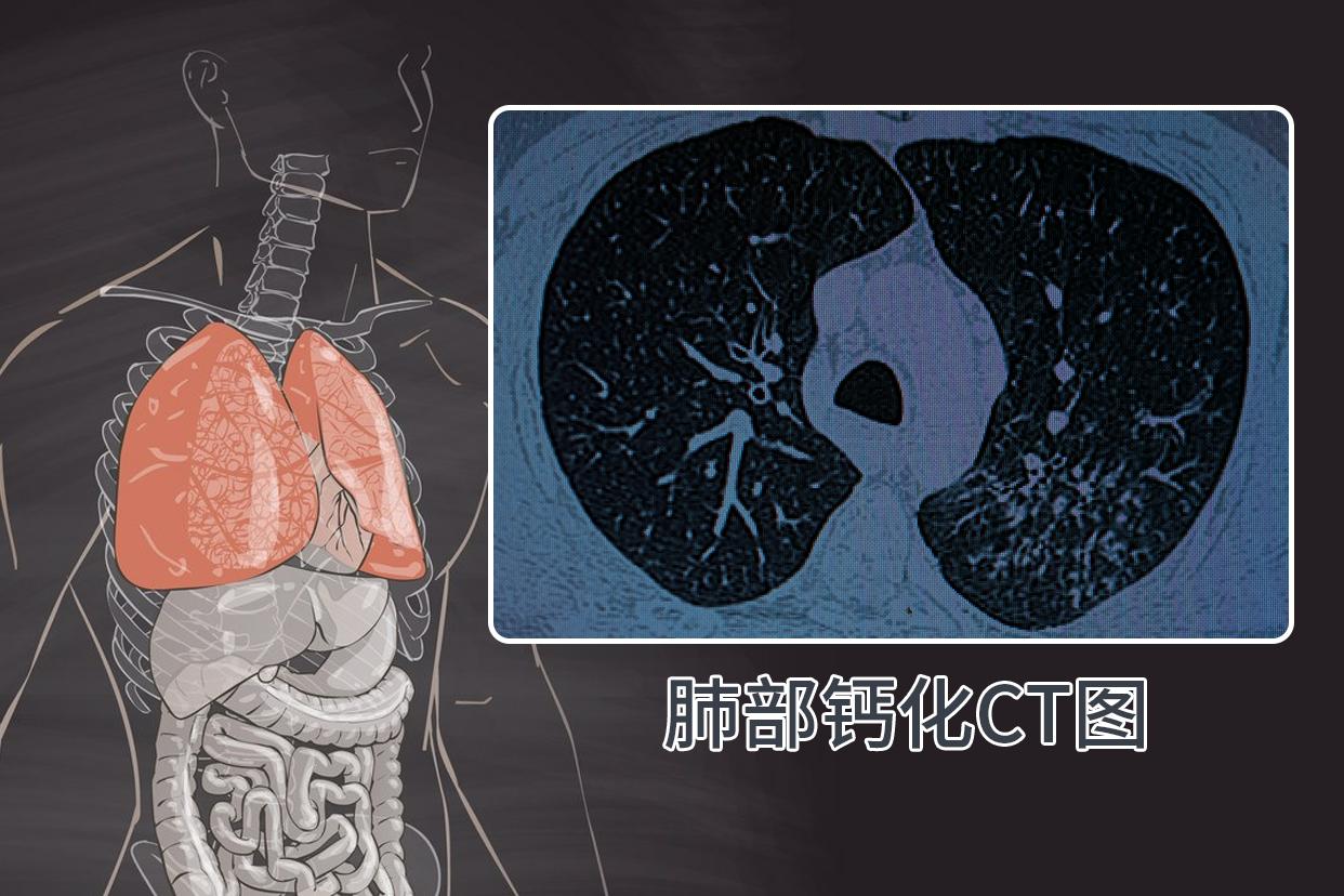 肺部钙化ct图像啥样的（肺部钙化ct表现）