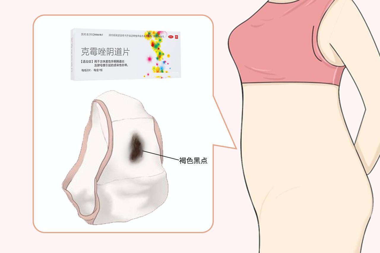 用了克霉唑排出褐色黑点正常吗图片 用完克霉唑有褐色的东西