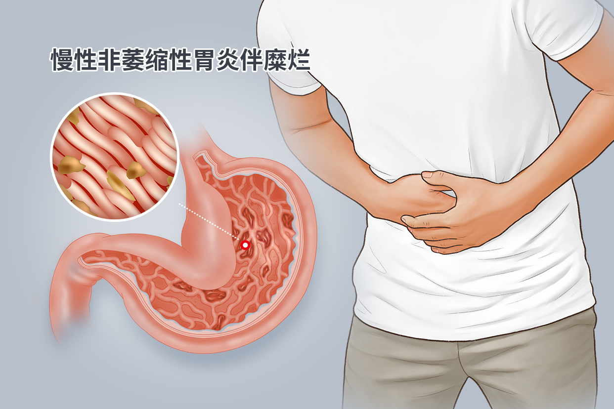 慢性非萎缩性胃炎伴糜烂图片 慢性非萎缩性胃炎伴糜烂症状和并发症和危害