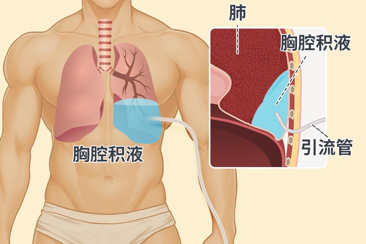 胸膜炎伤口引流管的位置图片（胸膜炎引流后 ,还感觉气紧是为什么）