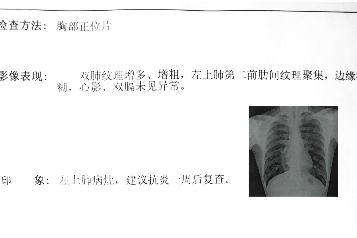 不正常的胸片图和报告 不正常的胸透图片