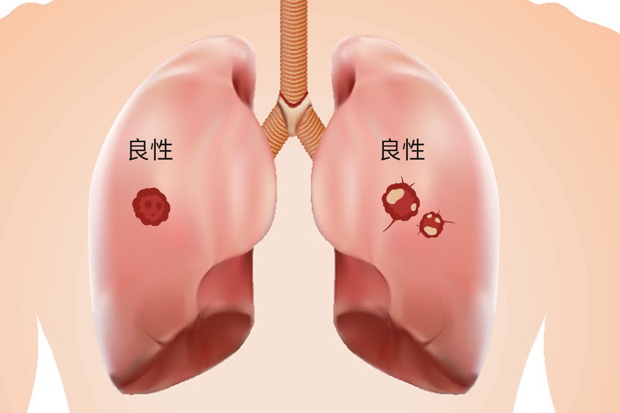 急性肺炎引起的肺结节有哪些种类图片