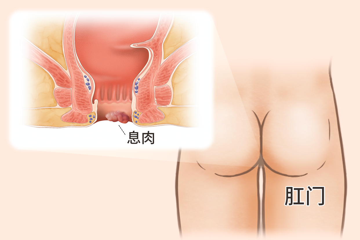 肛门肠息肉图片 肛门肠息肉图片大全大图