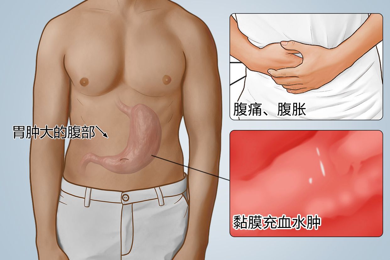 胃肿大的腹部图片（胃肿大有什么症状）
