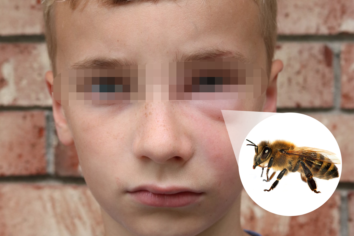 小孩被蜜蜂蛰了肿图片（小孩被蜜蜂蛰了的图片）