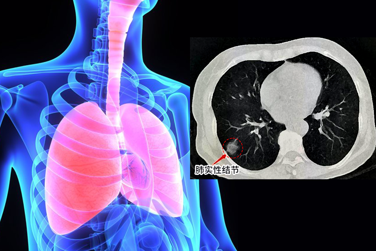 肺实性结节图片（肺实性结节图片大全）