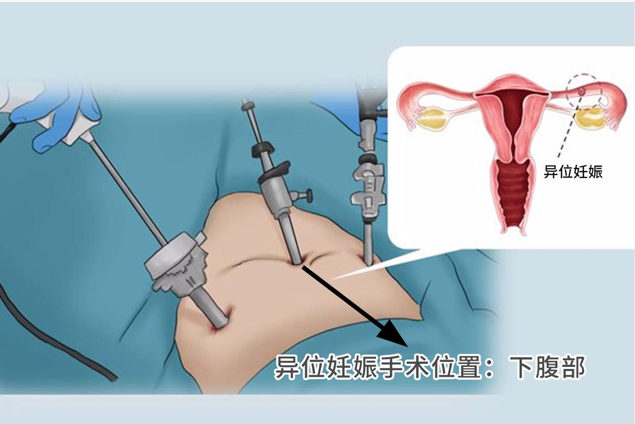 宫外孕手术在哪里开刀图（宫外孕手术在哪里开刀图片视频）