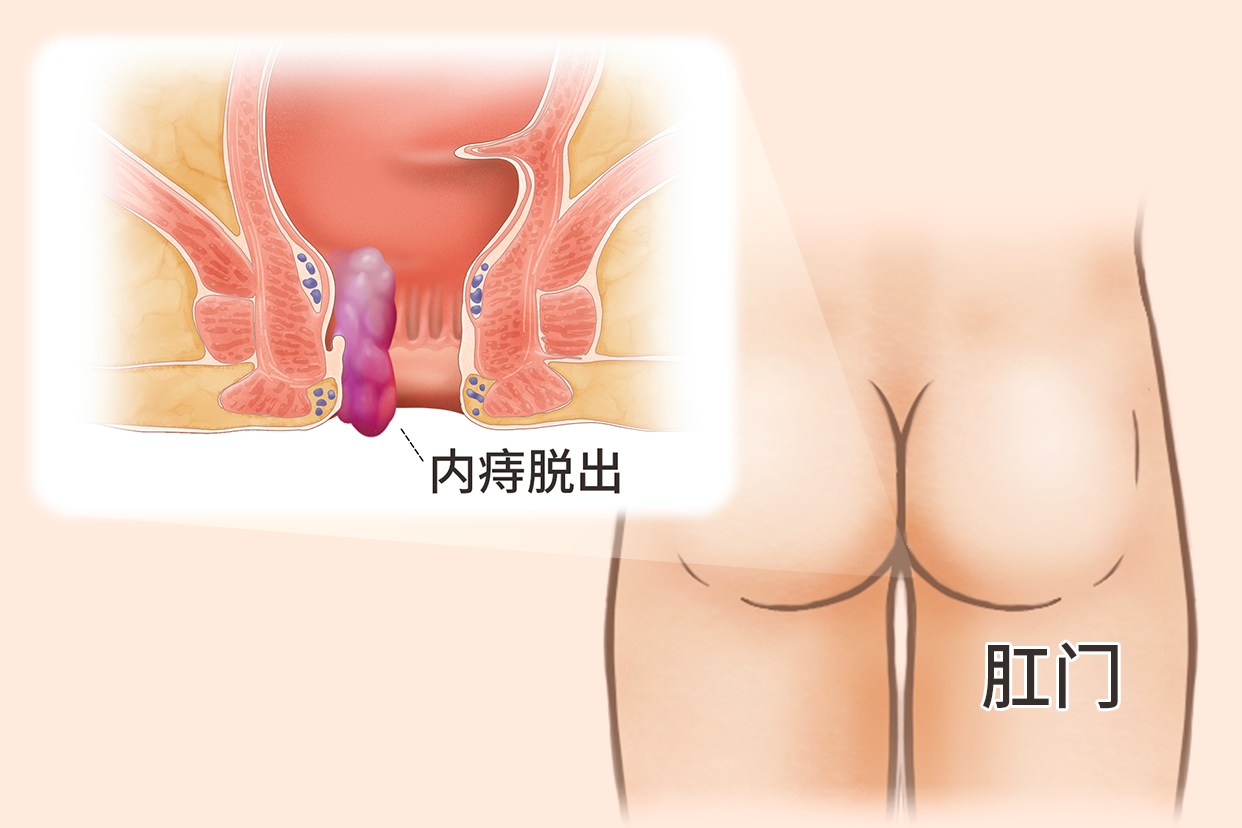 内痔痔核脱出的照片（内痔核脱落）