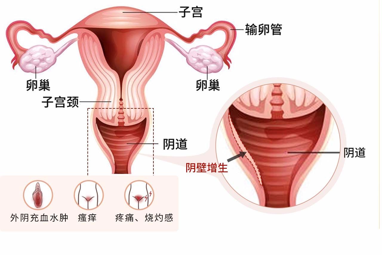 阴壁增生症状图片 阴壁增生肉芽咋回事