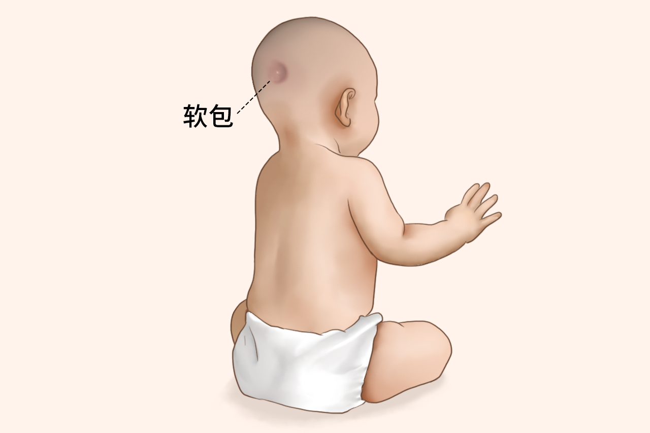 6个月婴儿后脑有个软包图片（6个月婴儿后脑勺有个包,摸着里面有颗东西）