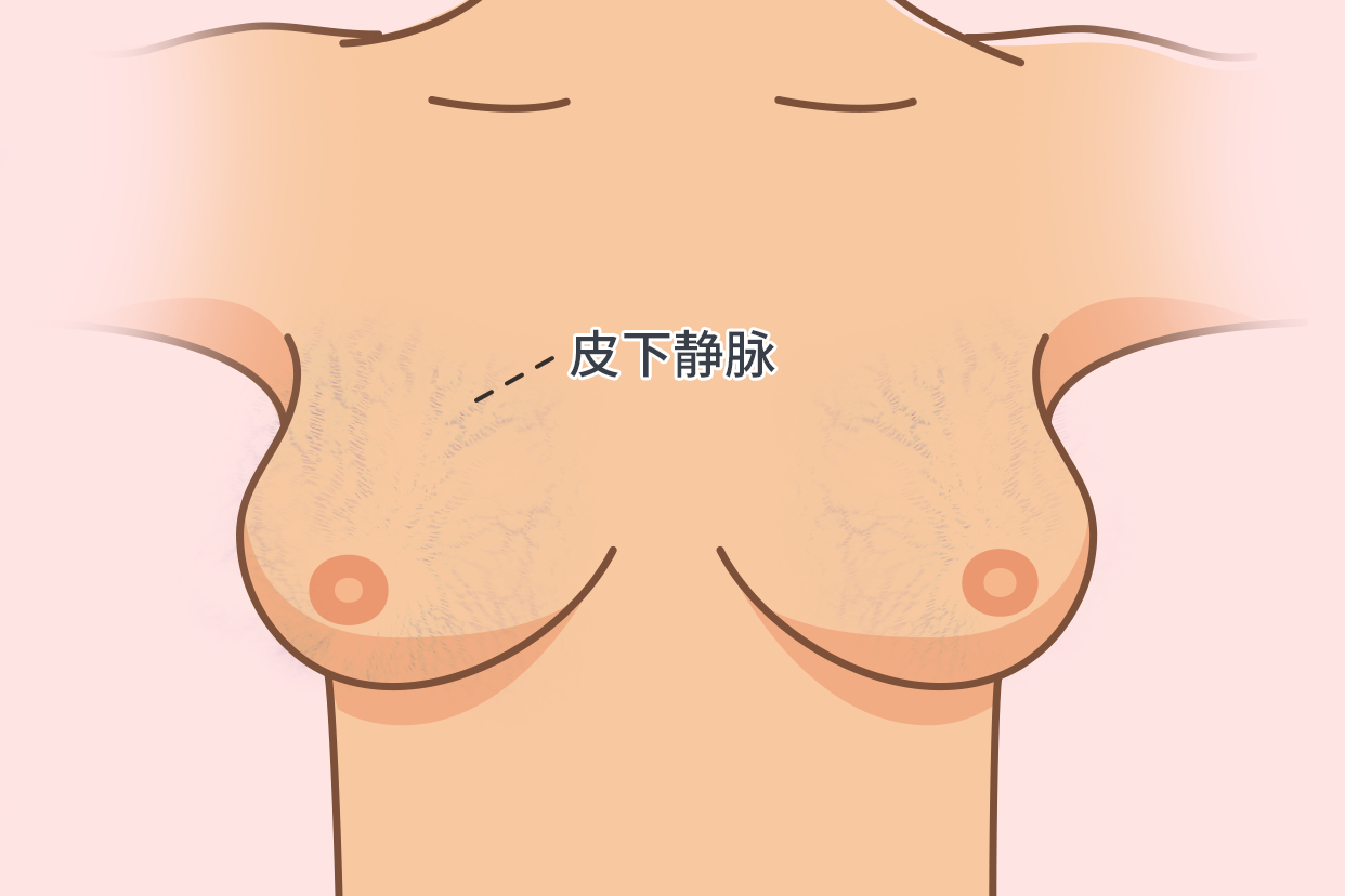 乳房皮下静脉图片 乳房皮下静脉图片解剖