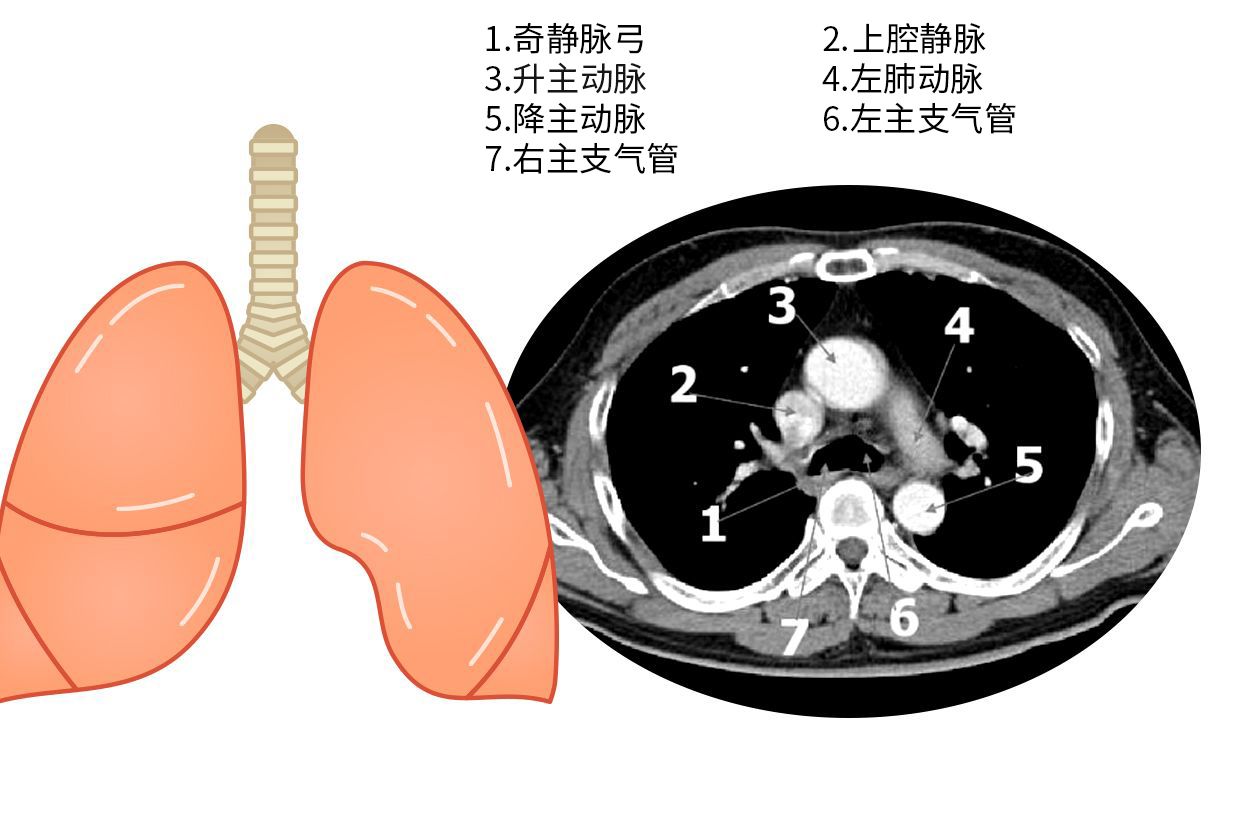 主动脉肺动脉窗图片 主动脉肺动脉窗位置