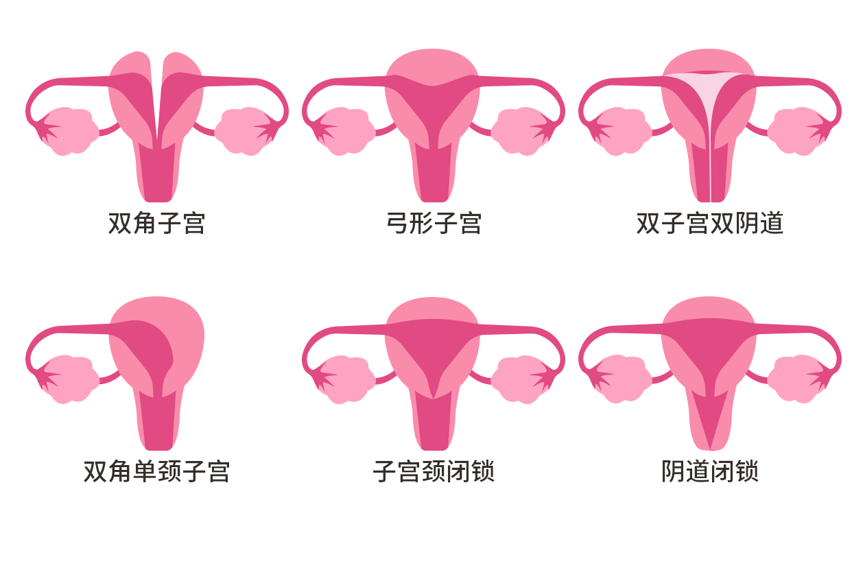 残角子宫示意图（残角子宫手术是微创还是开刀）