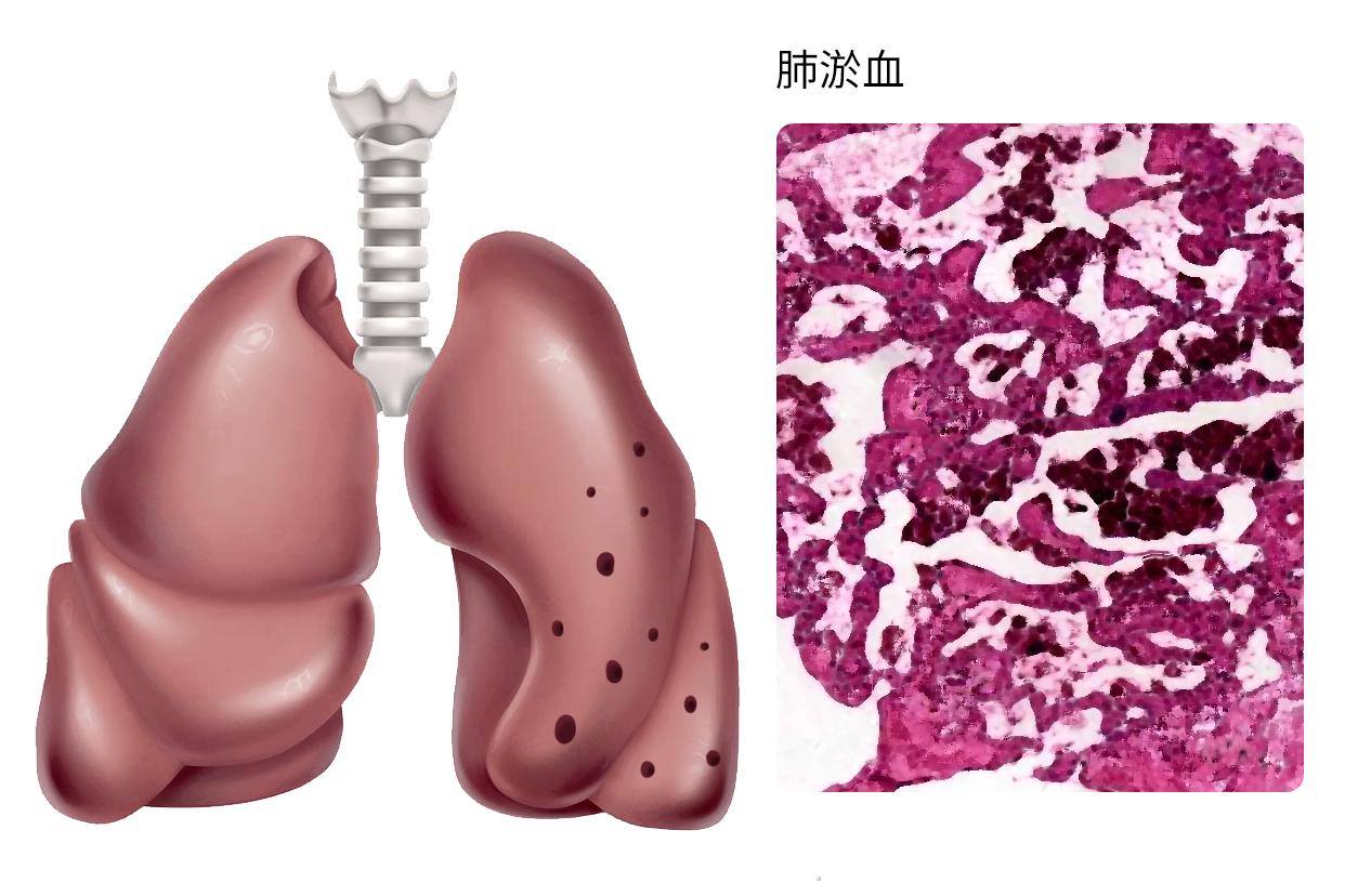 肺淤血图片（肺淤血图片 手绘图）