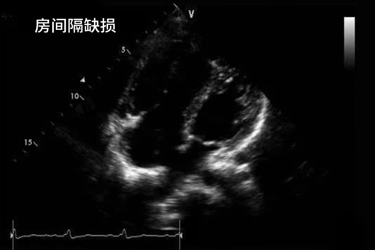 房间隔缺损超声心动图的特征 房间隔缺损超声心动图特征,错误的是