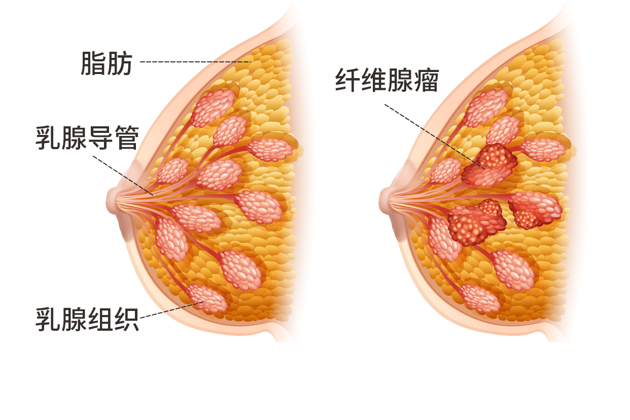 乳房上方纤维瘤图片 乳房上方纤维瘤图片大全