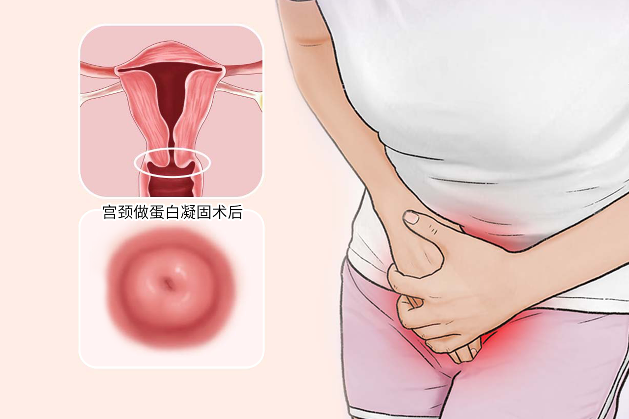宫颈做蛋白凝固术后图片 宫颈蛋白凝固术的注意事项