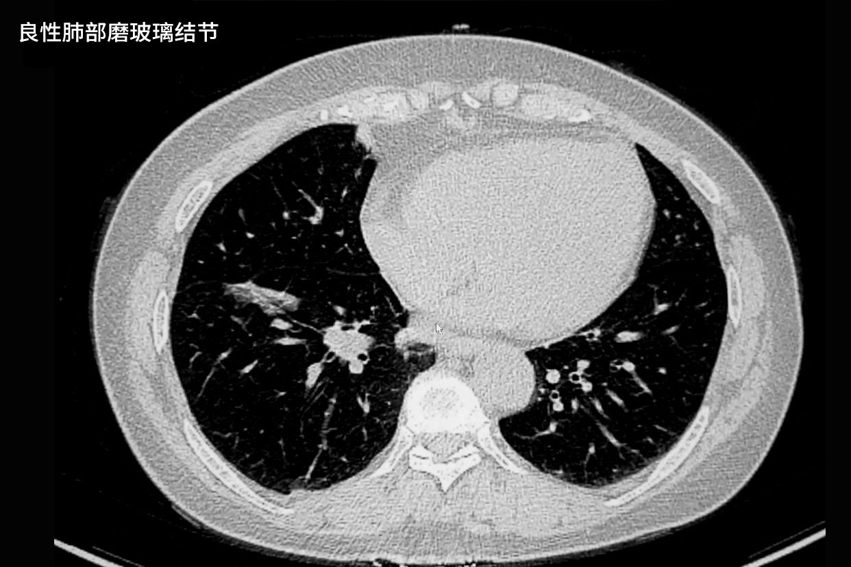 良性肺部磨玻璃结节影像图 良性肺部磨玻璃结节影像图片