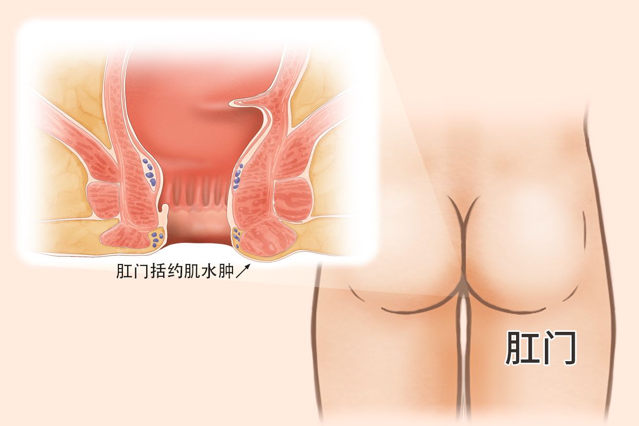 肛门括约肌水肿图片 肛门括约肌水肿疼痛怎么办