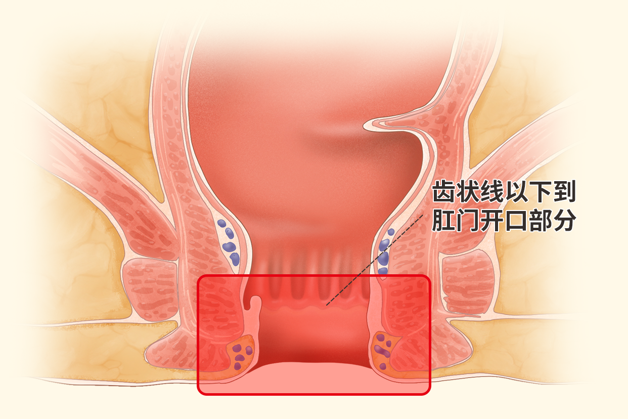 肛管癌位置图片（肛管癌的临床表现）