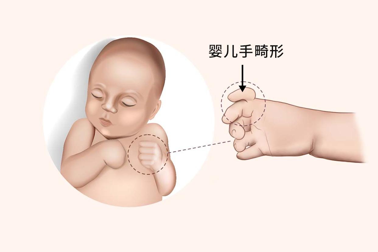 婴儿手畸形图片（婴儿手指畸形图片）