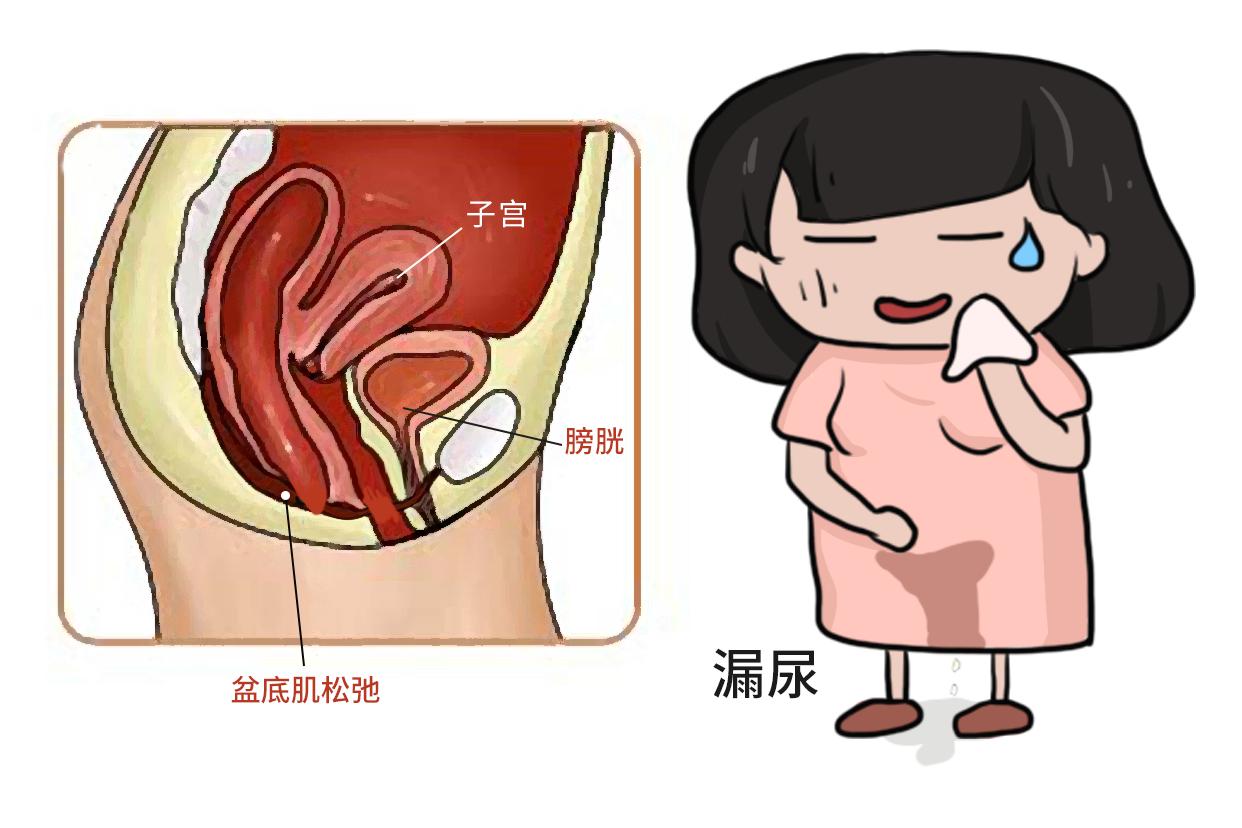 盆底肌松弛漏尿图片 盆底肌松弛漏尿如何做运动带图