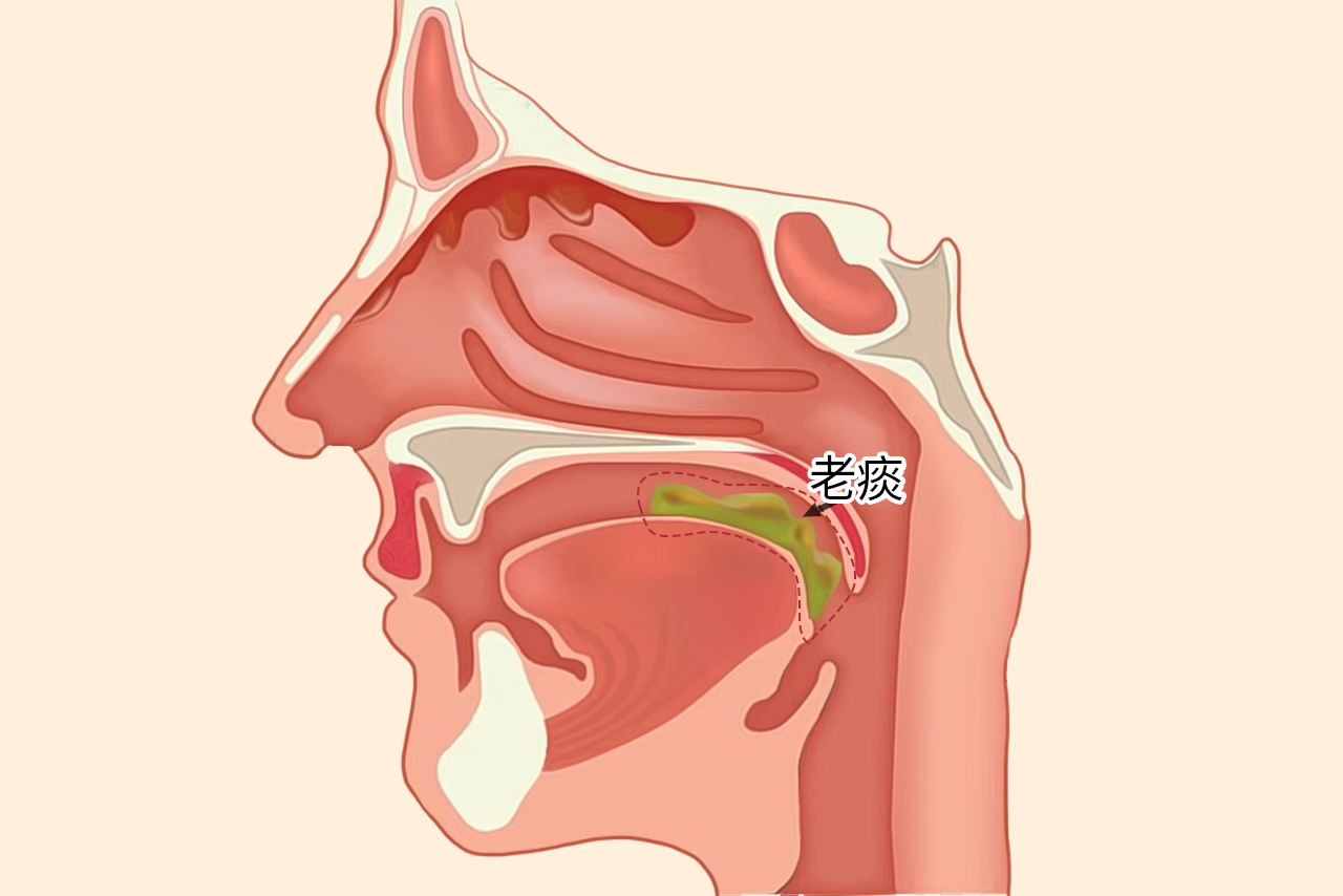 老痰图片 什么叫老痰