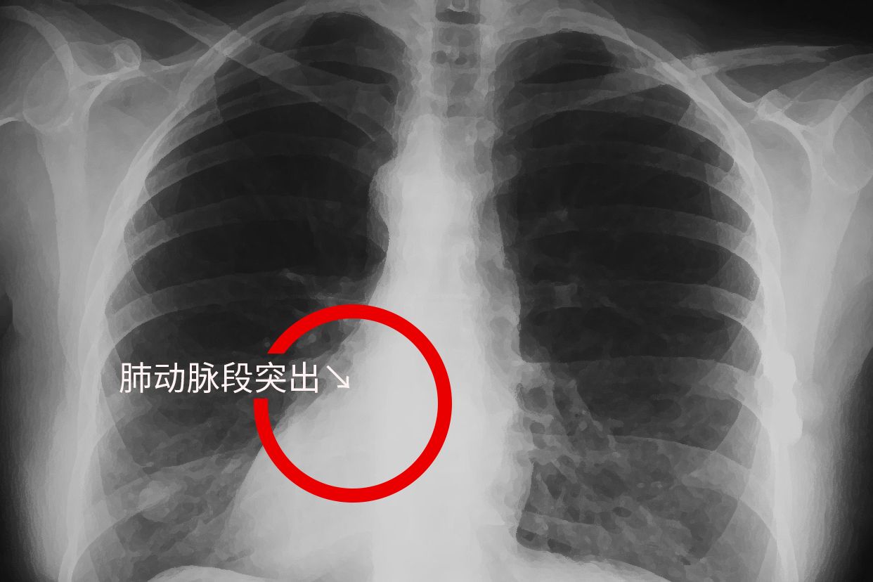 胸片肺动脉段突出图片 胸片肺动脉段突出图片大全