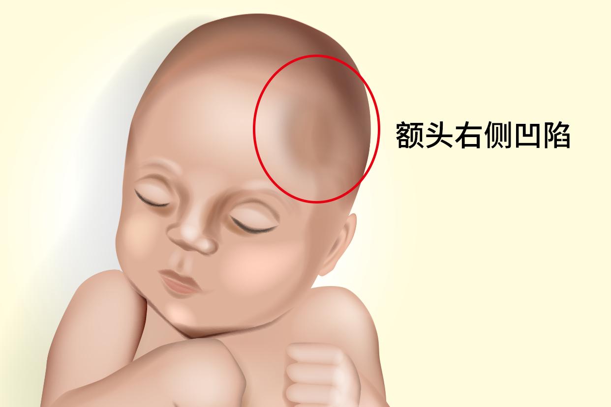 宝宝额头右侧凹陷图片 宝宝额头右侧凹陷图片大全
