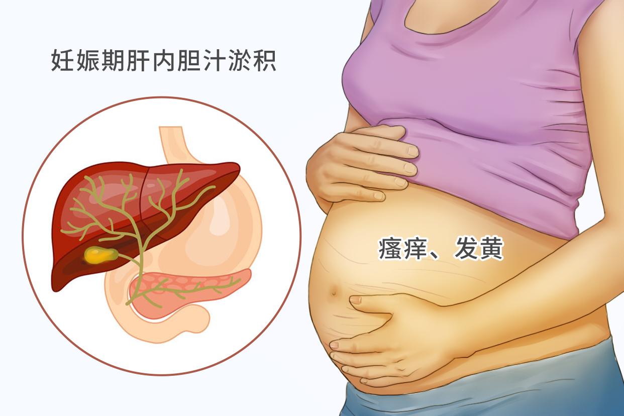 孕妇胆淤和湿疹的图片 孕妇湿疹与胆汁淤积