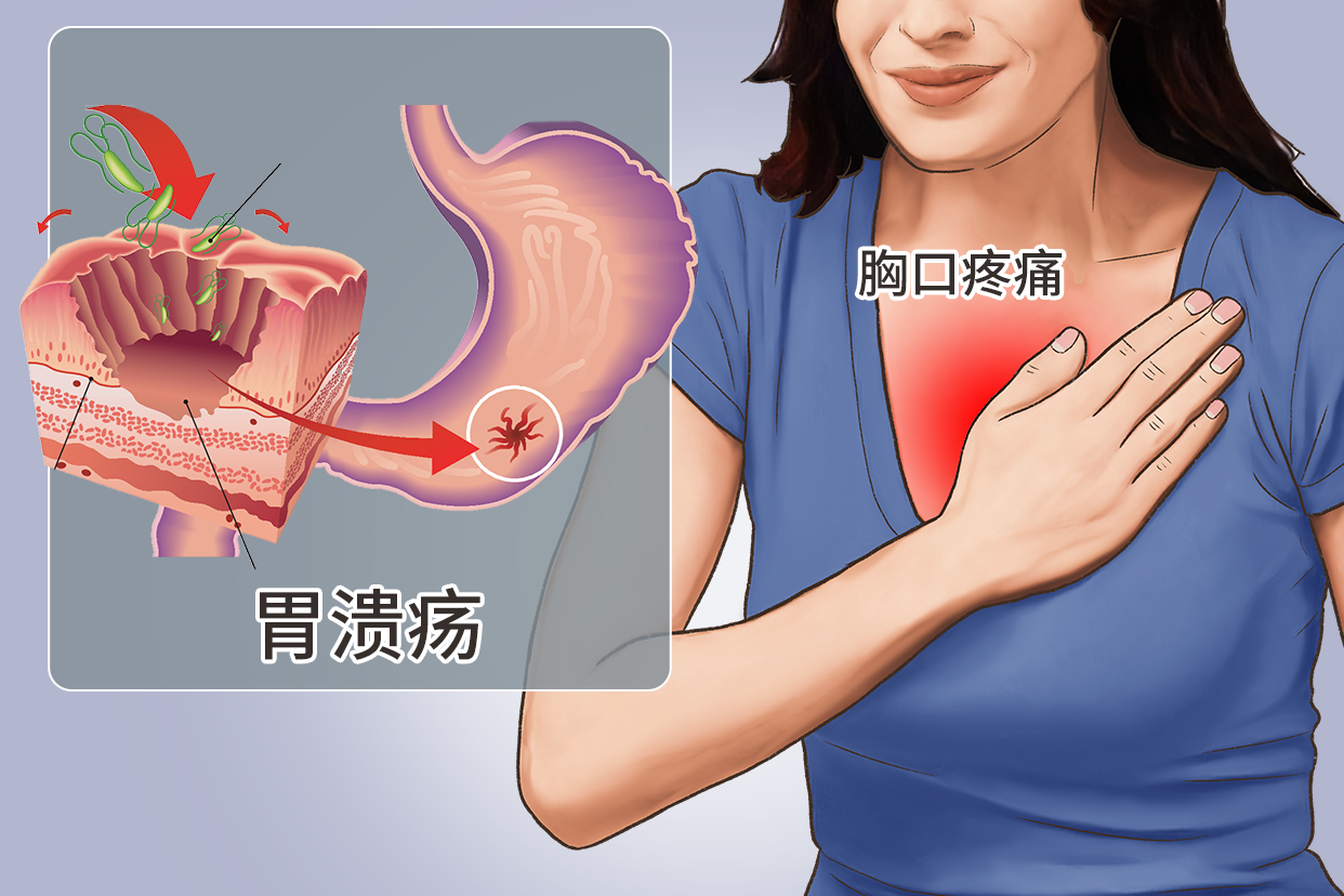 胃溃疡胸口疼位置图 胃溃疡胸疼怎么办