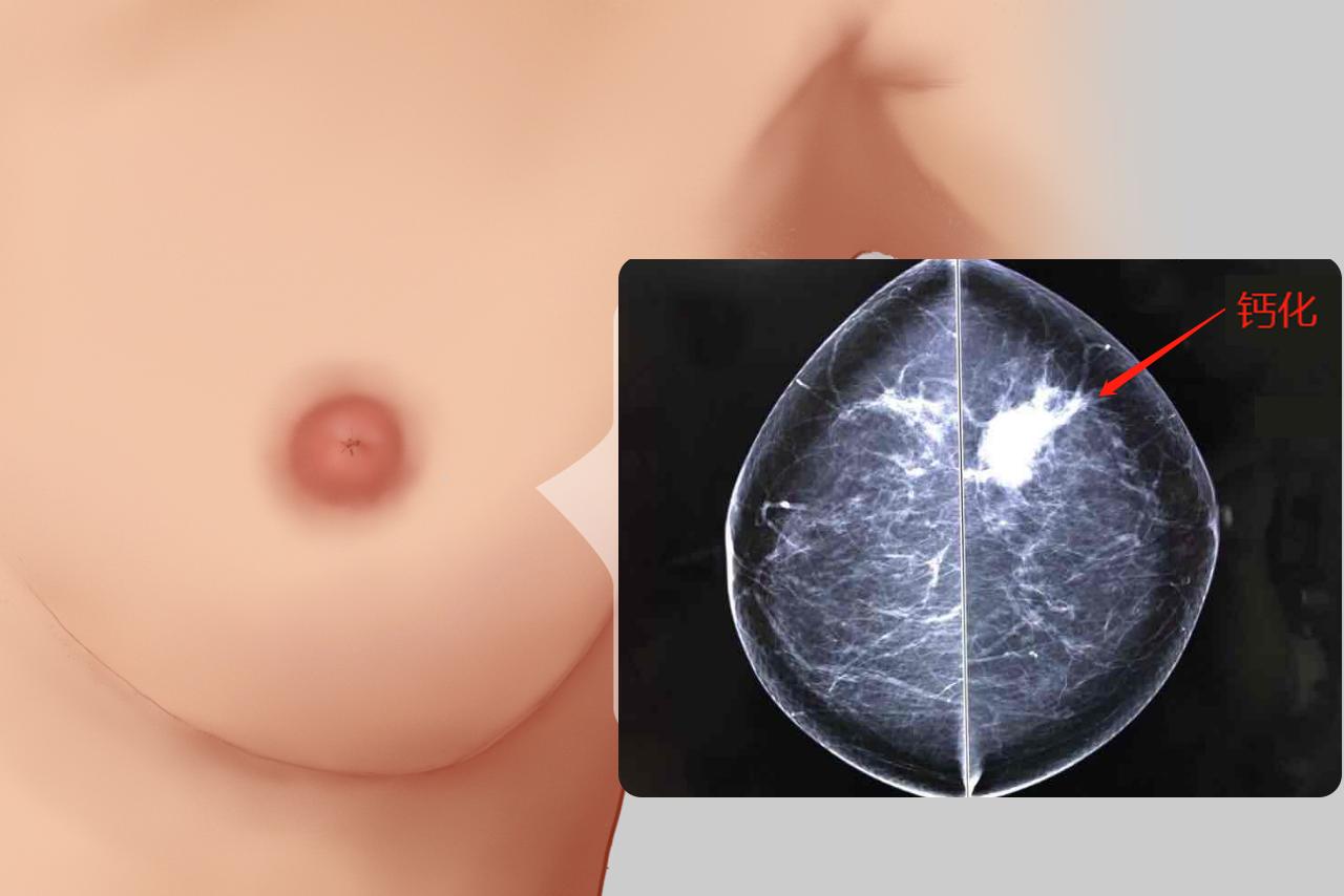 乳腺癌钙化图片 乳腺癌钙化灶图片