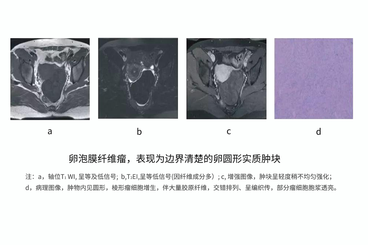 纤维卵泡膜细胞瘤图片（纤维卵泡膜细胞瘤是良性还是恶性）