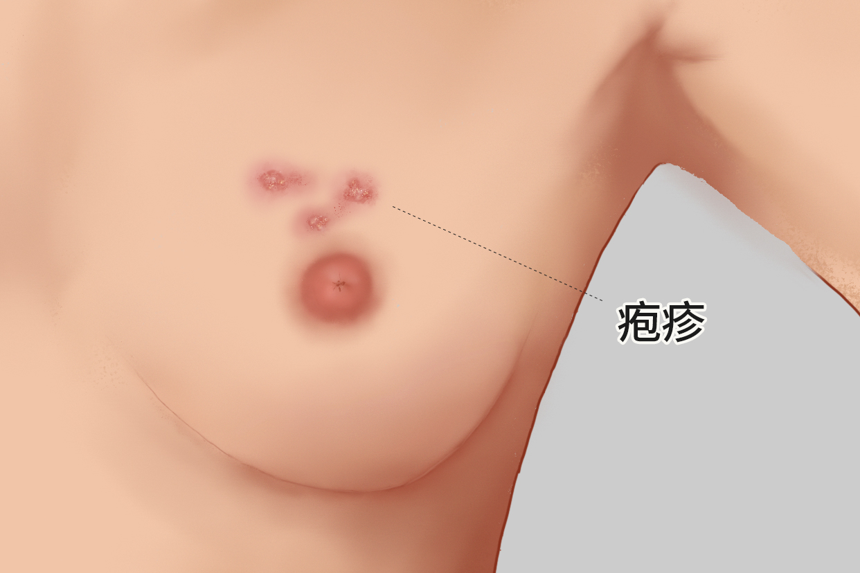 女性乳房长疱疹图样 乳房长疱疹是怎么回事