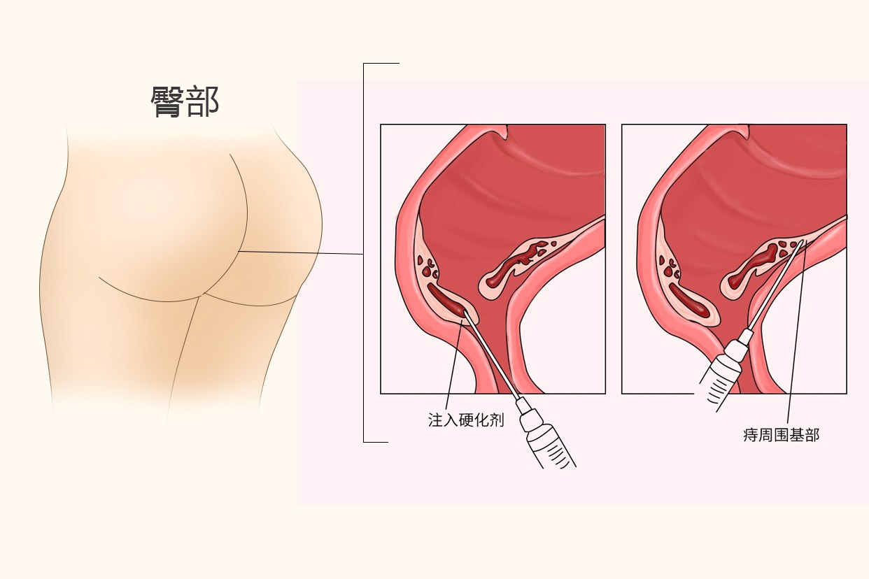 痔疮打针后一个星期后图片