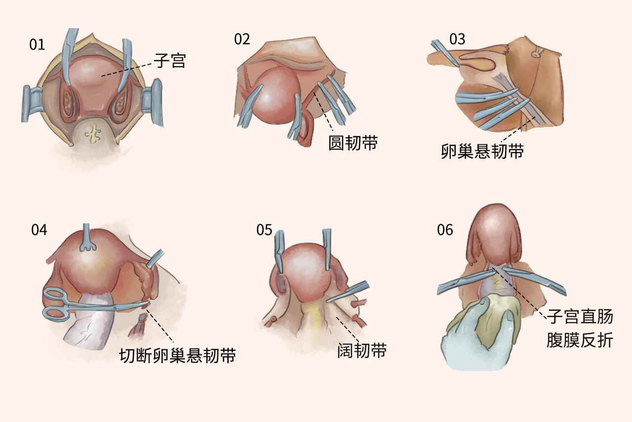 子宫卵巢的切除手术示意图
