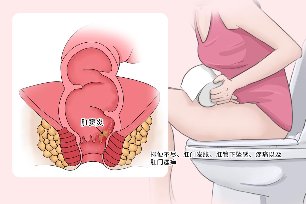 女性肛窦炎的症状图片