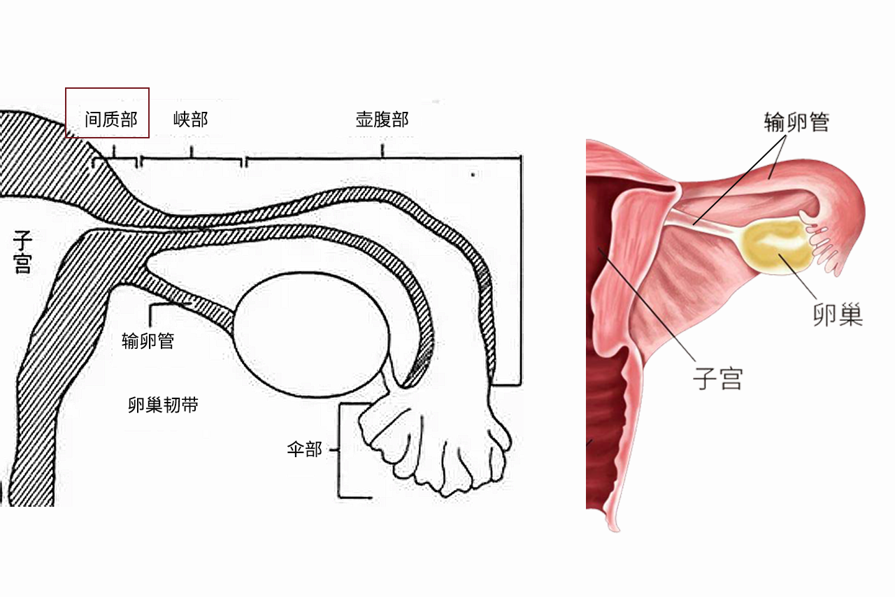 输卵管间质部图片