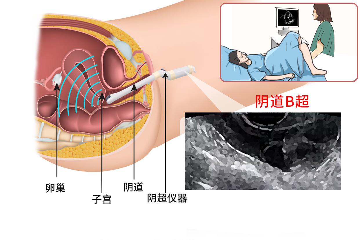 阴道b超图